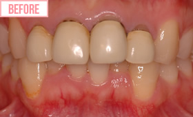 セラミック矯正施術前1