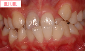 アクトレス矯正施術前1