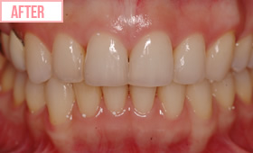 ワイヤー矯正施術後1