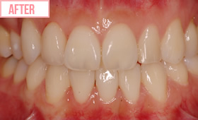 ワイヤー矯正施術後2
