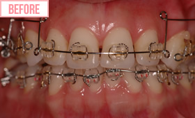 ワイヤー矯正施術前1