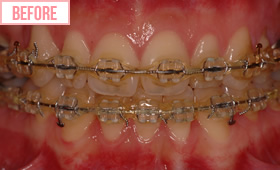 ワイヤー矯正施術前2