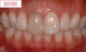 セラミック人工歯施術前1