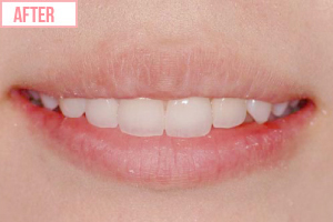セラミック矯正施術後2