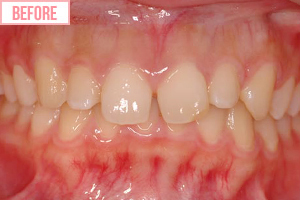 セラミック人工歯施術前2