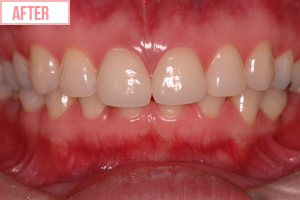 歯に貼るセラミック1歯施術後