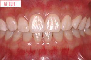 クリスタル・ホワイトafter2