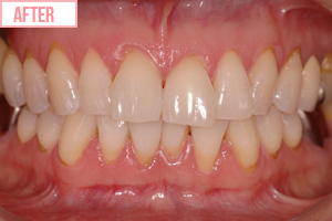 クリスタル・ホワイトafter2