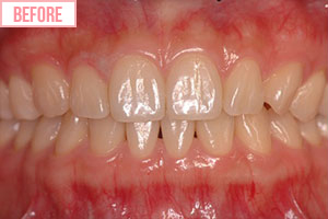 クリスタル・ホワイトbefore2