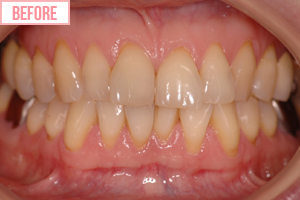 クリスタル・ホワイトbefore1