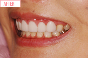 歯ぐきの整形施術後2