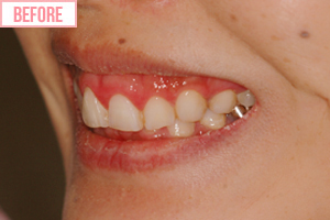 歯ぐきの整形施術前2