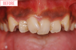 歯ぐきの整形施術前3