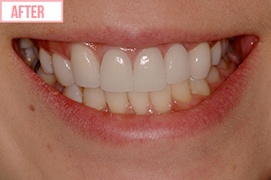 アクトレス矯正施術後2