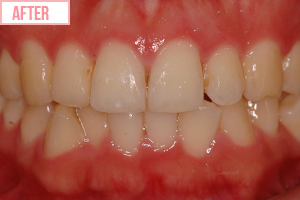 見えない外せる矯正施術後