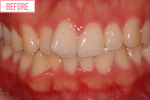 見えない外せる矯正施術前