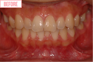 ダイエット矯正施術前