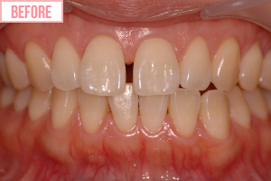 短期ワイヤー矯正施術前