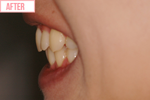 通常期ワイヤー矯正施術後2