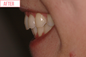 片側 通常期ワイヤー矯正施術後2