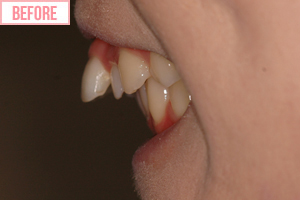 片側 通常期ワイヤー矯正施術前2