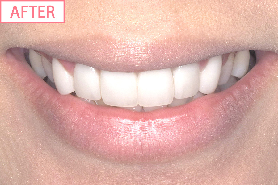 高級スマイルライン6本セット＋歯肉整形after