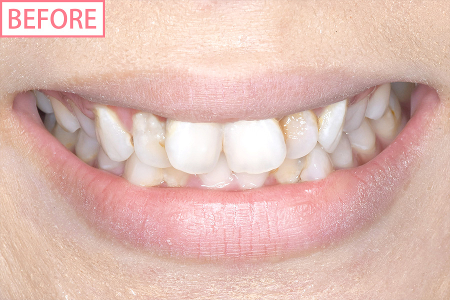 高級スマイルライン6本セット＋歯肉整形before