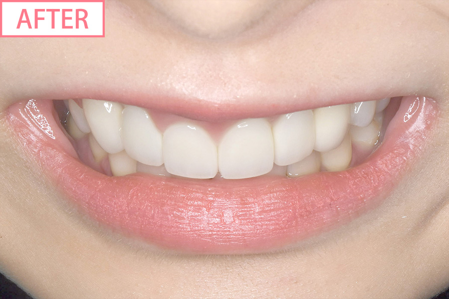 アクトレス矯正after