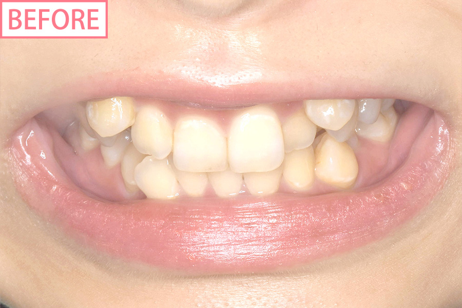 アクトレス矯正before