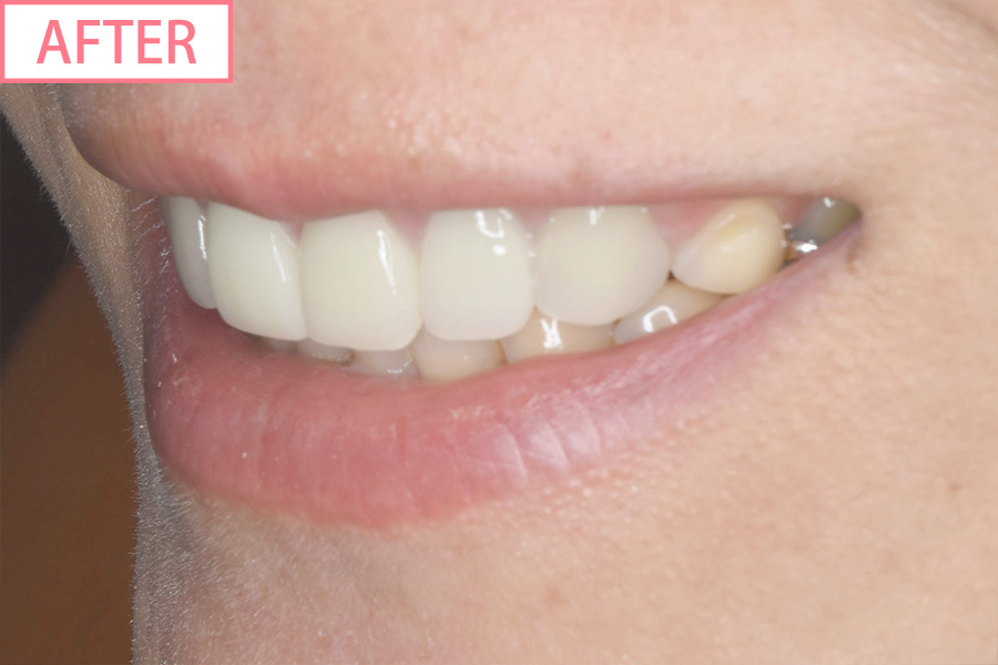 高級スマイルライン6本セットafter