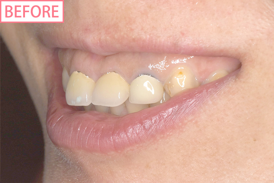 高級スマイルライン6本セットbefore