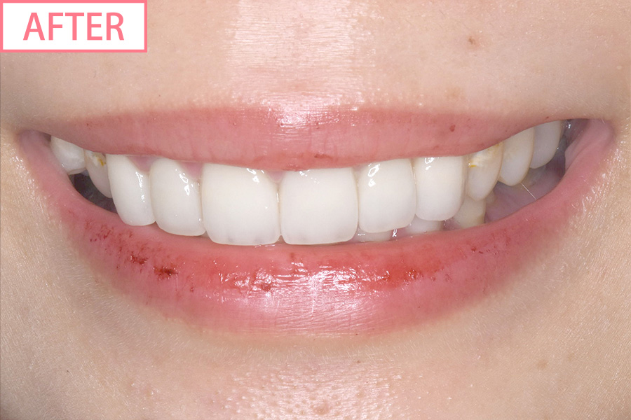 高級スマイルライン6本セットafter