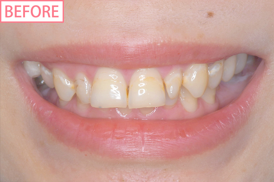 高級スマイルライン6本セットbefore