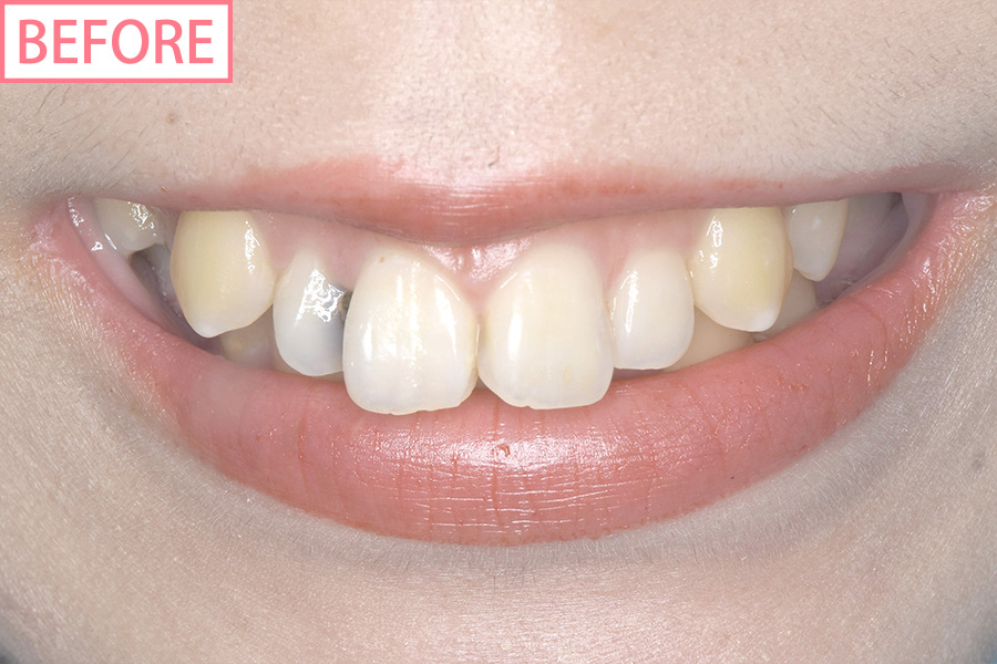 高級スマイルライン6本セットbefore