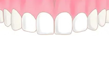 スマイルラインセットのafter