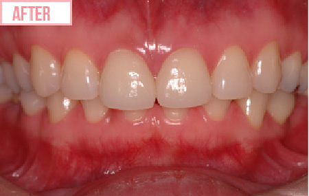 ラミネートべニアのafter