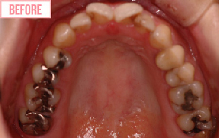 セラミックインレーのbefore