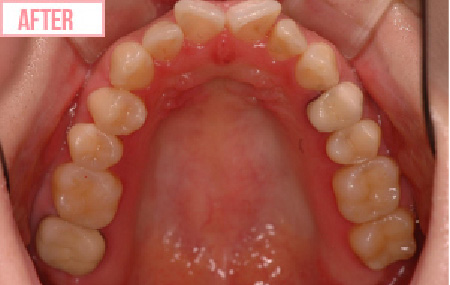 セラミックインレーのafter