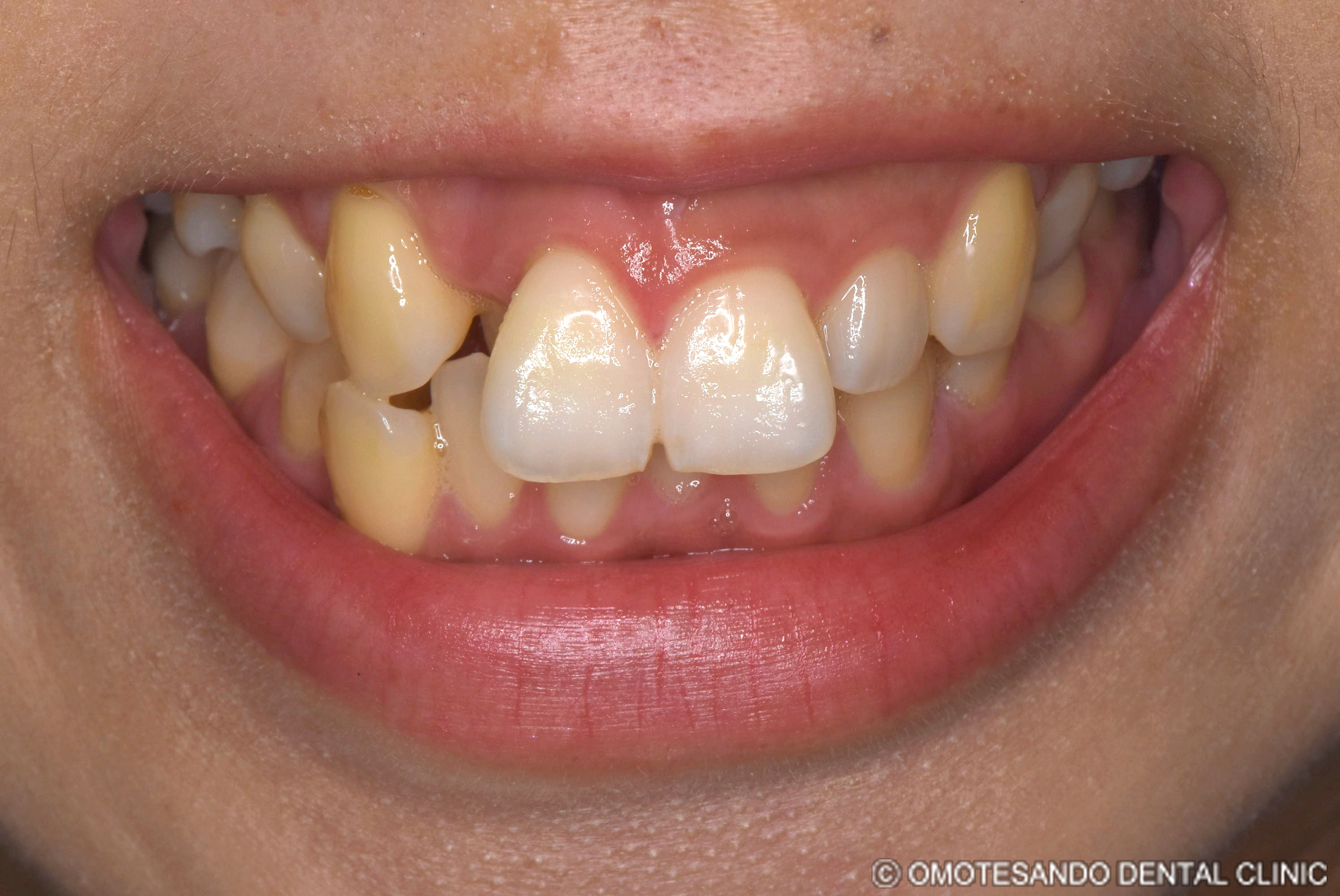 ガミースマイルアクトレス矯正30代女性_フロント_before