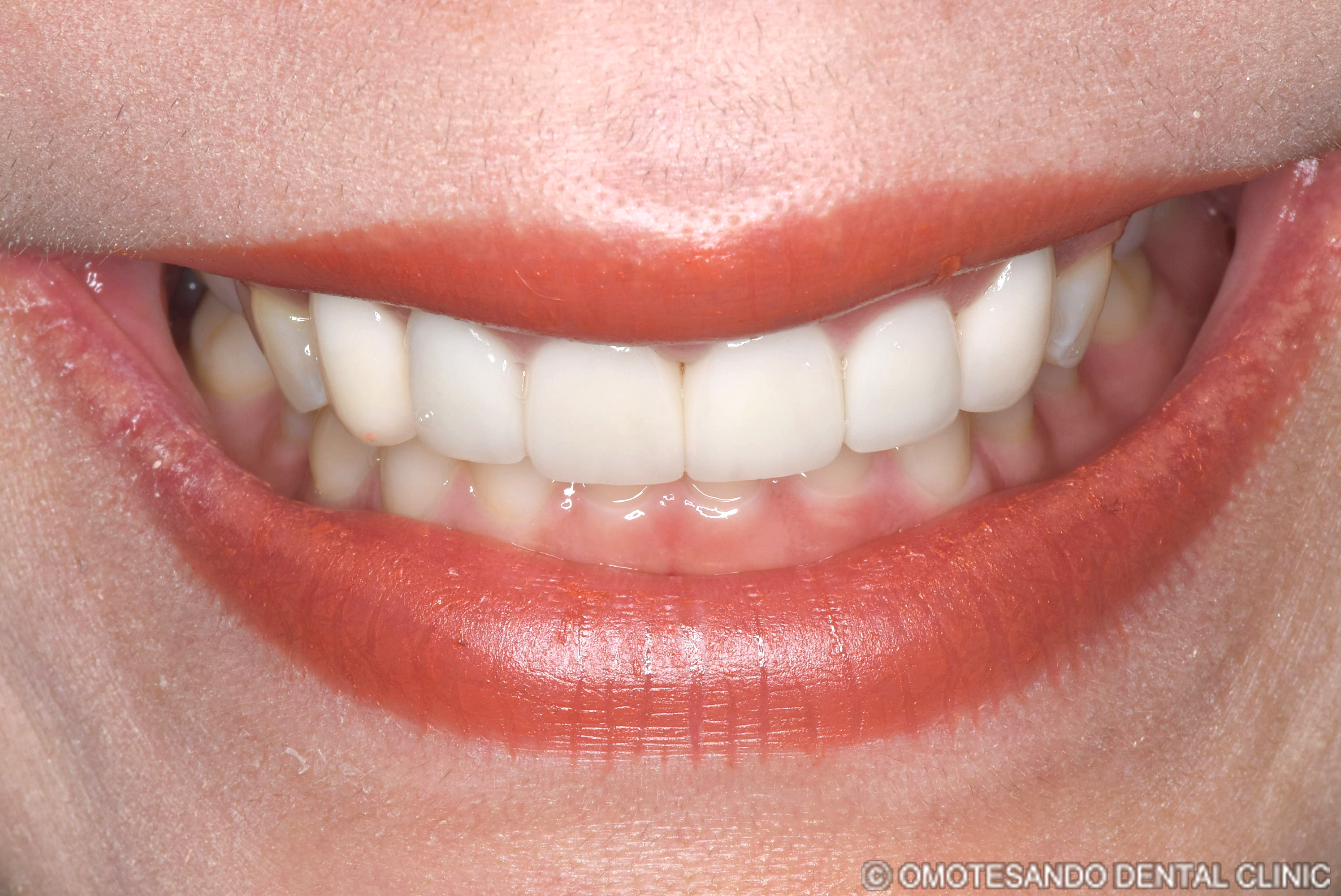 ガミースマイルセラミック矯正20代女性_フロント_after