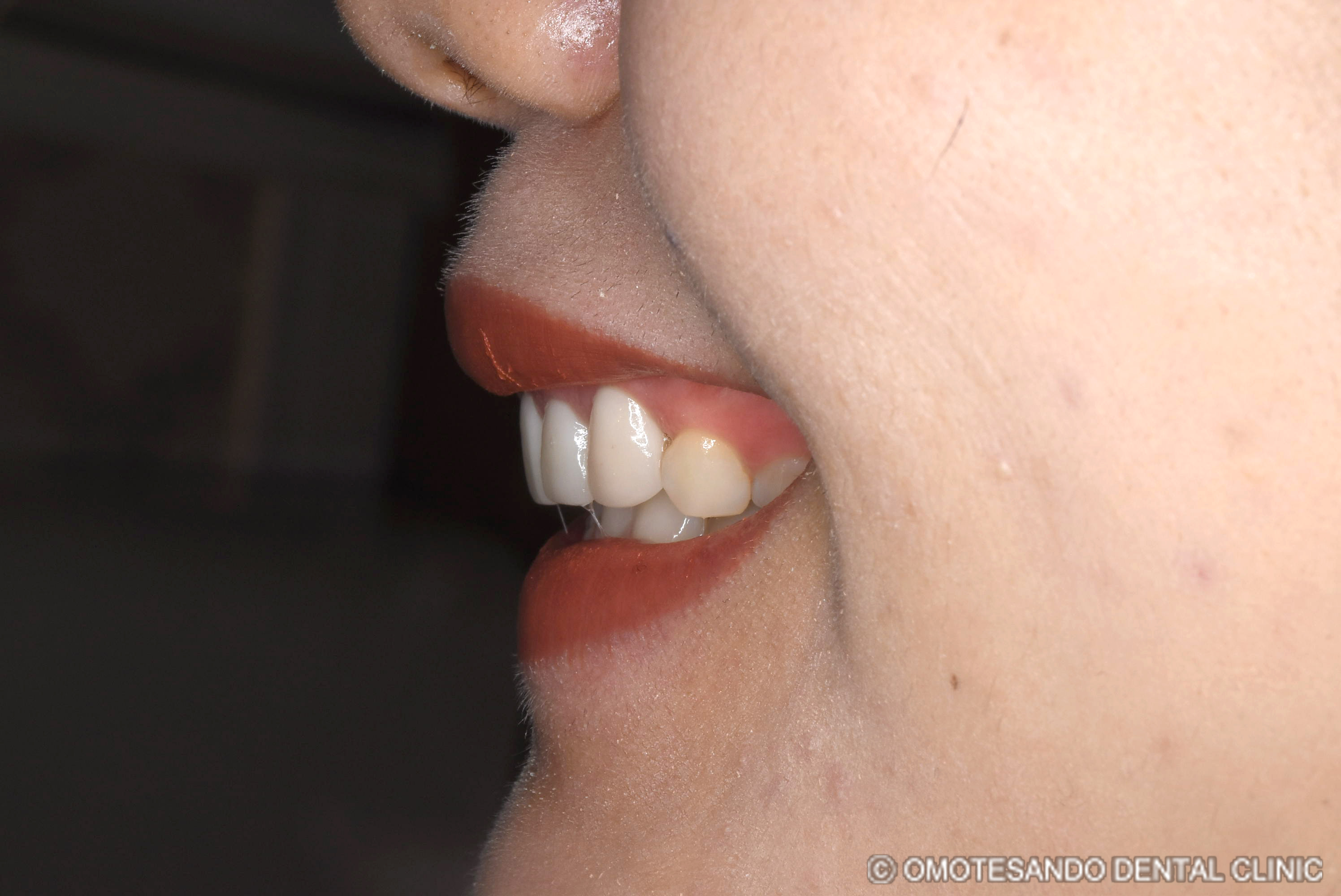 ガミースマイルセラミック矯正20代女性_サイド_after