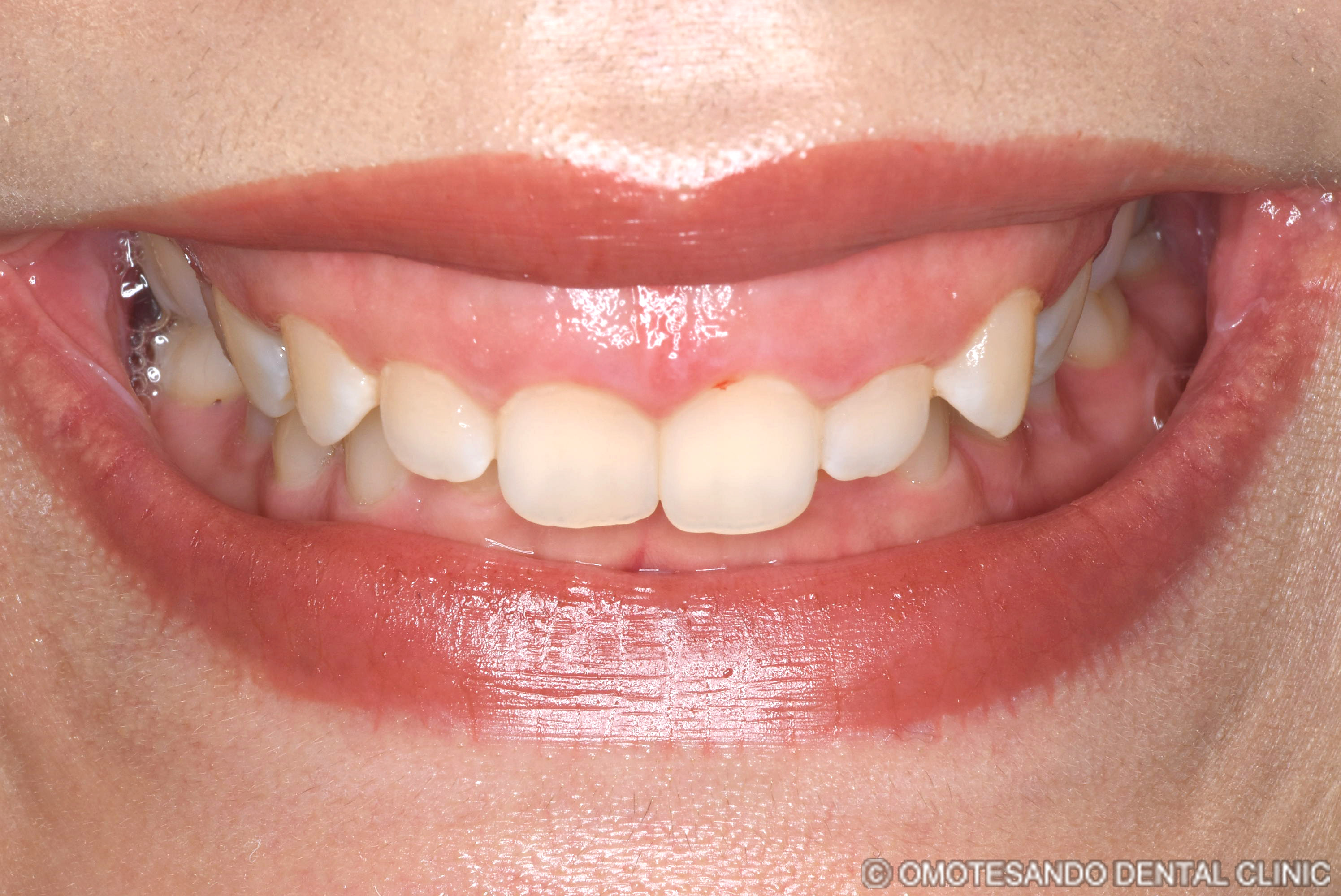 ガミースマイルセラミック矯正20代女性_フロント_before