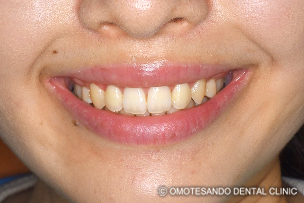 ガミースマイルワイヤー矯正（圧下矯正）20代女性_フロント_after