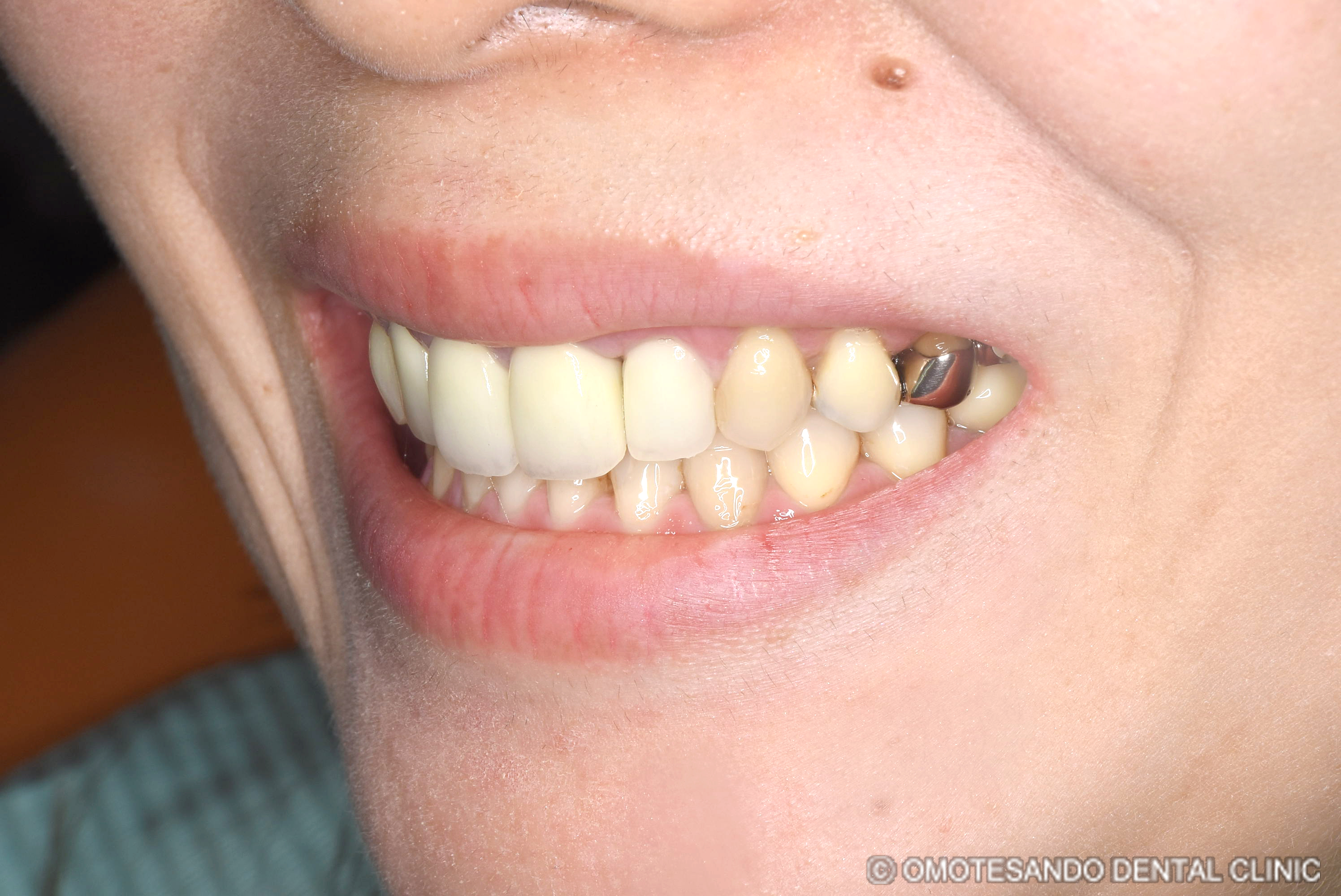 ガミースマイルワイヤー矯正＋セラミック矯正30代女性_斜め_after