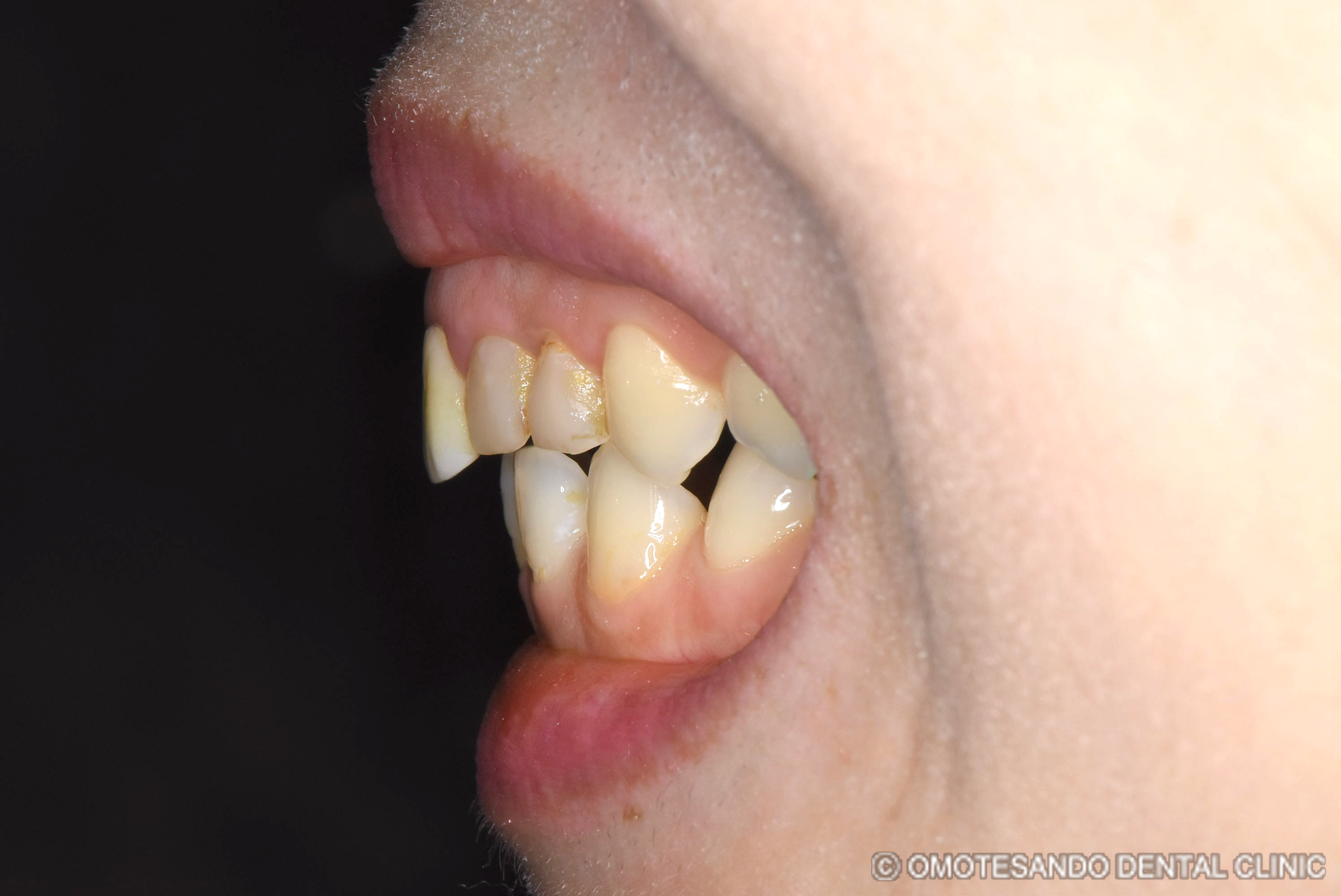 ガミースマイルワイヤー矯正＋セラミック矯正30代女性_サイド_before