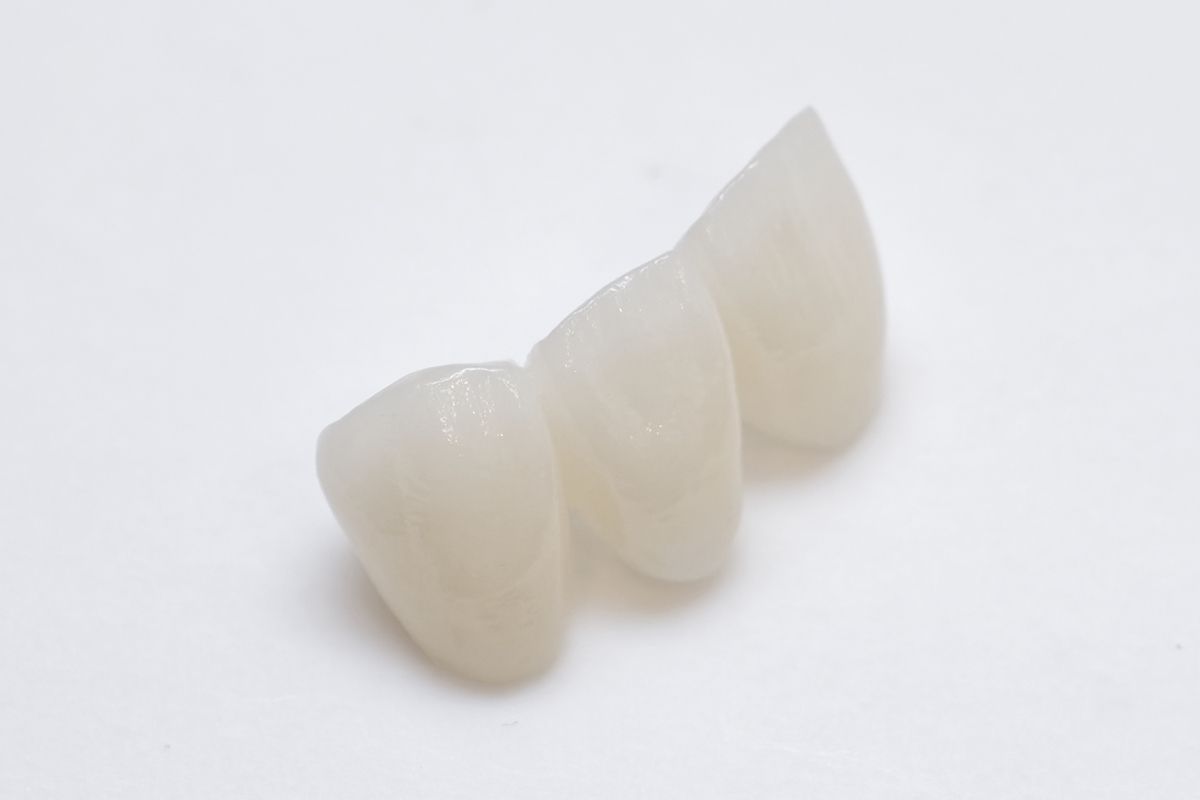 エステティックデザインオールセラミック歯