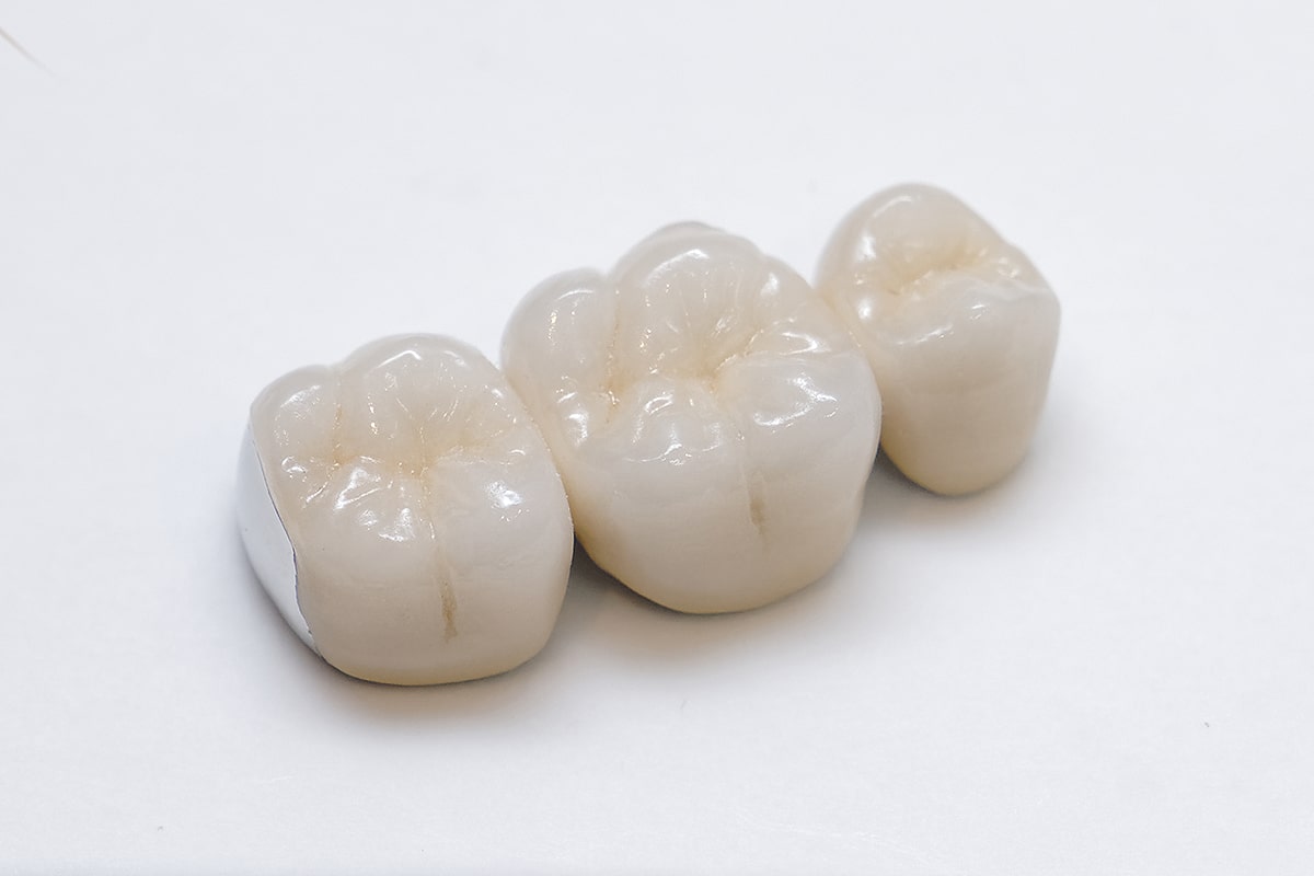 メタルボンドセラミック歯