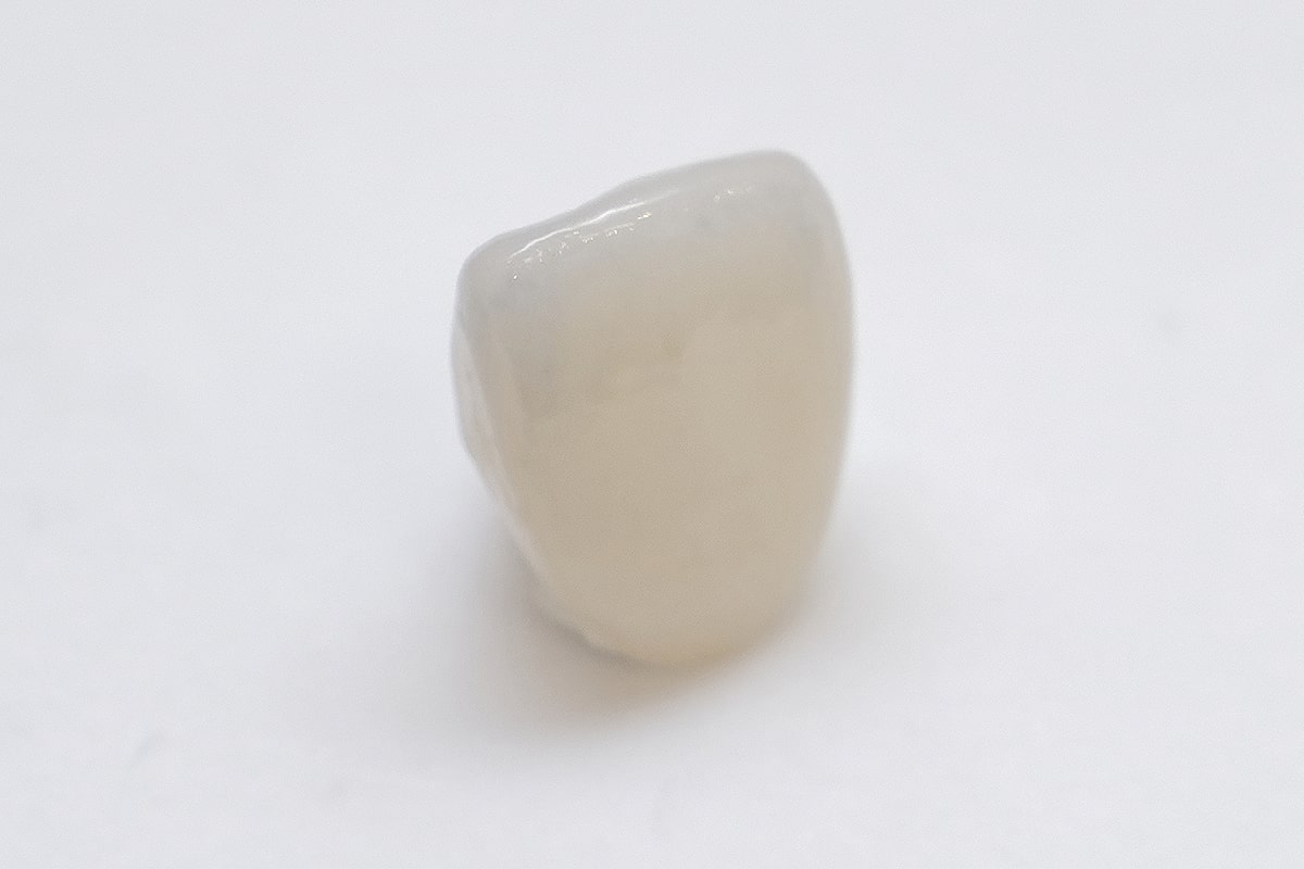 前歯ホワイトジルコニアクラウン