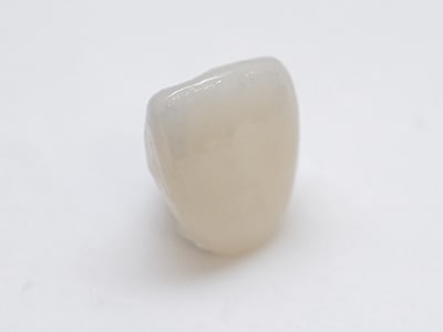 前歯ホワイトジルコニアクラウン