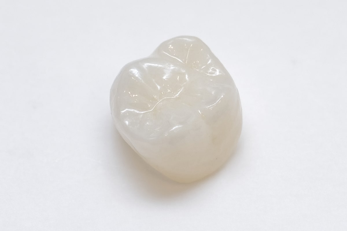 奥歯ホワイトジルコニアクラウン